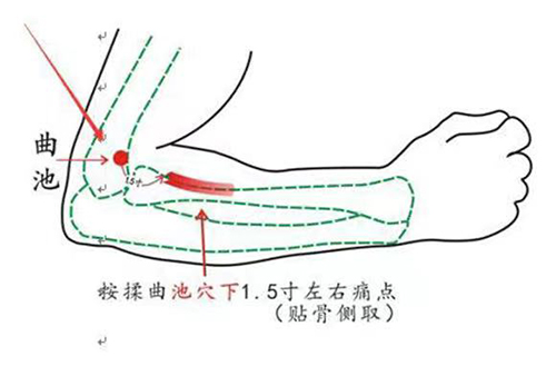 苏州国医堂孙国荣：曲池穴如何缓解疼痛(图1)