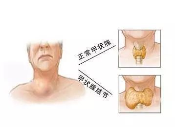 苏州国医堂张禾：如何预防甲状腺结节(图1)