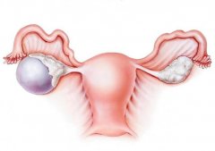 卵巢囊肿的病因，以及苏州治疗卵巢囊肿