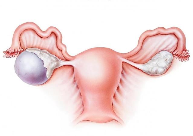 卵巢囊肿的病因，以及苏州治疗卵巢囊肿(图1)