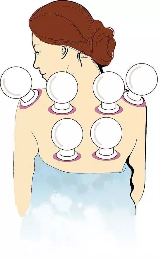 拔罐真的可以增加老年人的抵抗力吗？(图1)